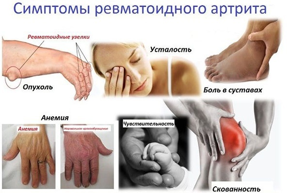 Rheumatoid arthritis. Diagnosis of blood, etiology, pathogenesis, causes, symptoms and treatment