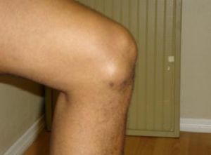 Escolhendo um método para tratar o higroma do joelho