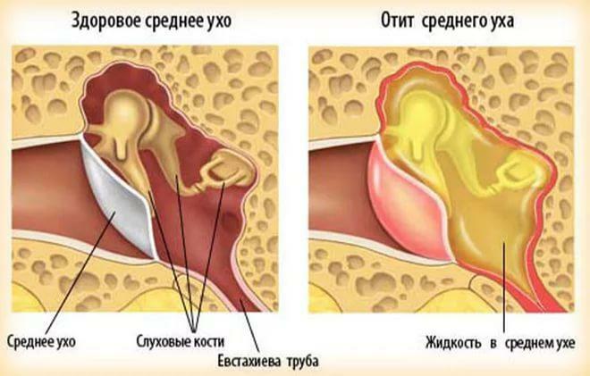 La différence entre une oreille saine et une oreille avec otite moyenne