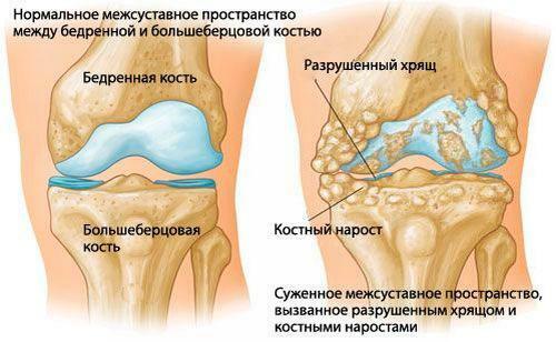 Changements dystrophiques du cartilage du genou