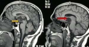 craniopharyngioma mozga na mrt