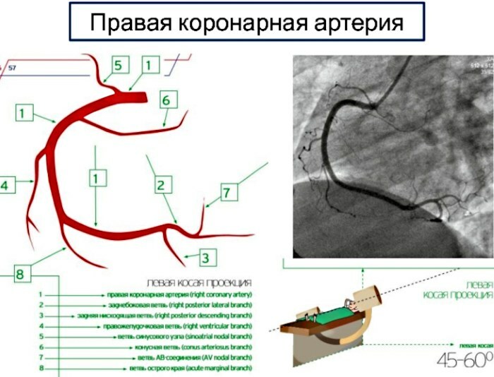 Koronararterien des Herzens. Schema, Anatomie, was ist das, CT, Ultraschall, Foto