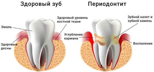 שיניו של מבוגר רופפות. סיבות, טיפול, כיצד לחזק את החניכיים, תרופות
