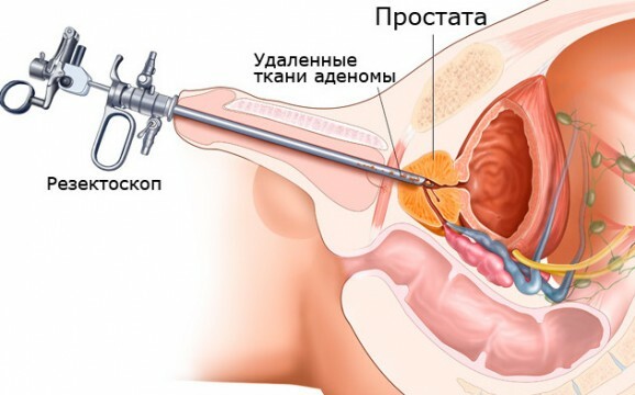 Operation for at fjerne prostatisk adenom