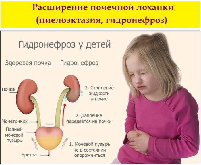 Pyelektase av nyrene hos et barn, voksne, foster. Hva er det, symptomer, årsaker, behandling