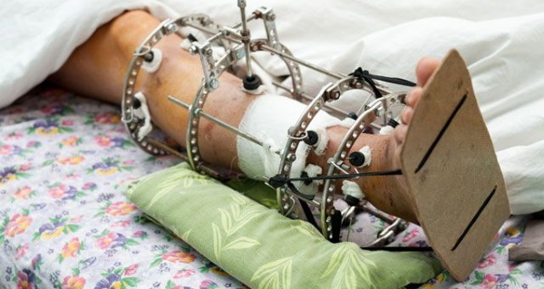 Ilizarovo aparatas ant kojos, rankos, šlaunies. Montavimas, nuotrauka kaip, kiek dėvėti, prižiūrėti