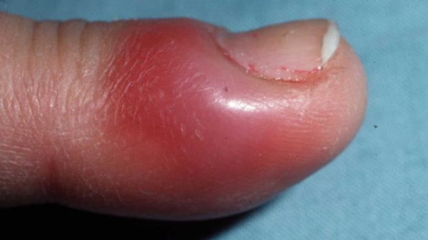Toe panaritium. Symptoms and Treatment