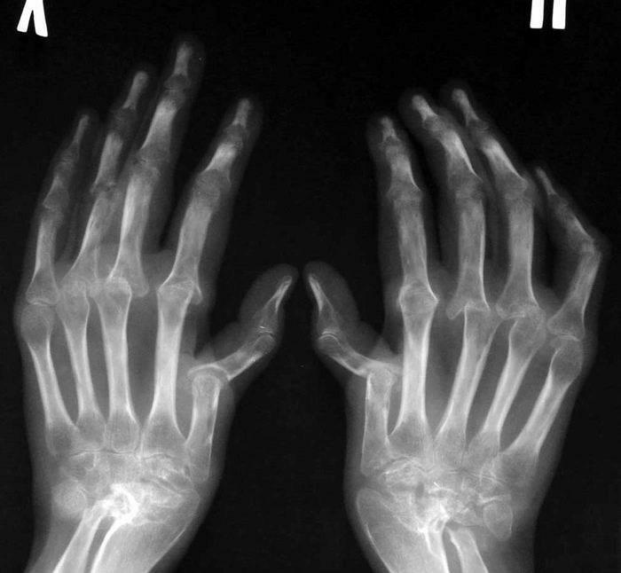 Rheumatoid arthritis - X-ray