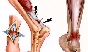 Stretch of the ligament of the foot