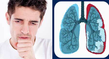 Symptoms of pulmonary pneumosclerosis