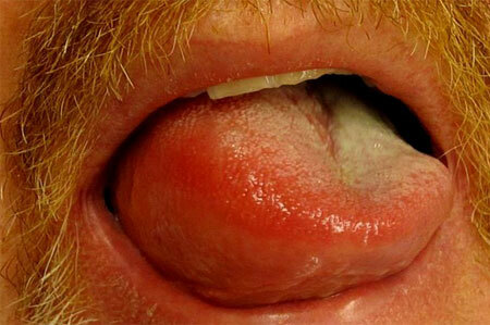 Symptoms of angioedema in adults