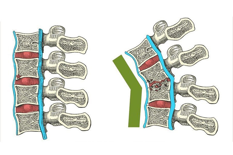 Tubercolosi della colonna vertebrale e delle ossa