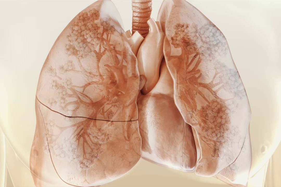 Lungefibrose