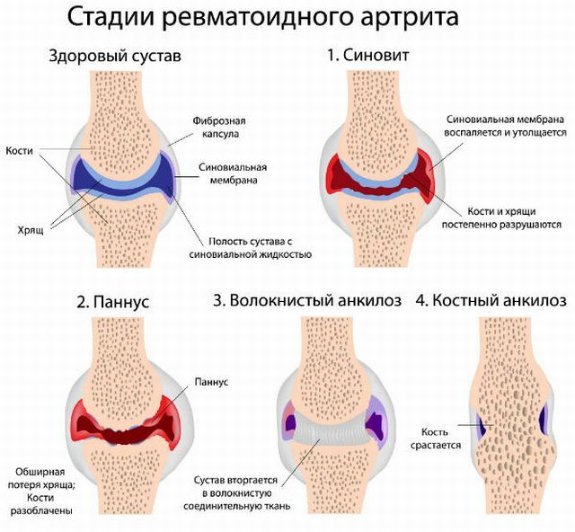 Stadier af arthritis