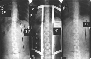 Radiografi til skoliose