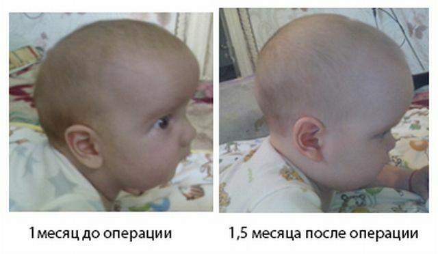Avant et après la chirurgie pour la correction du crâne