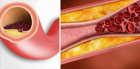 Cholesterol plaques