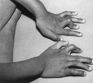 príčiny kontraktúry prstov