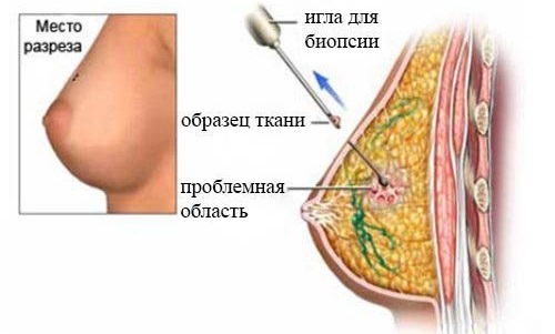 breast fibroadenoma. What is it, symptoms, how to treat people's means, the operation. The leaf, filloidnaya, intrakanalikulyarnaya