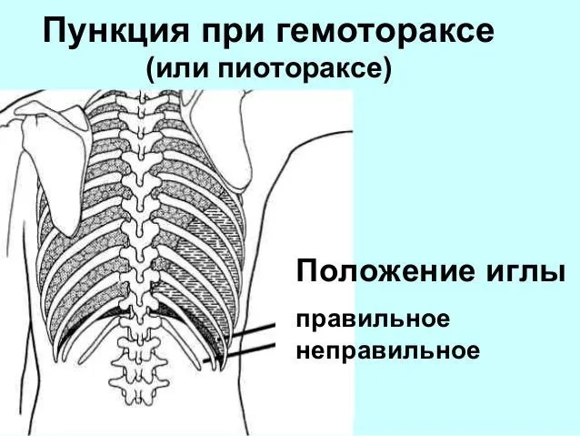 Пункция плевральной жидкости. Пункция плевральной полости межреберье. Плевральные пункуия при гематороксе. Пункция плевральной полости при гемотораксе. Техника плевральной пункции при пневмотораксе и гемотораксе.