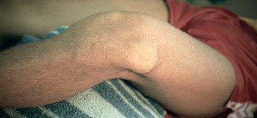 Dislocación de la articulación de la rodilla