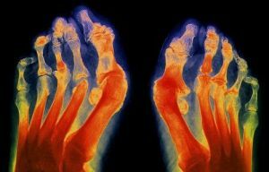 reumatoïde artritis