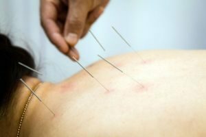akupunktur for osteochondrose