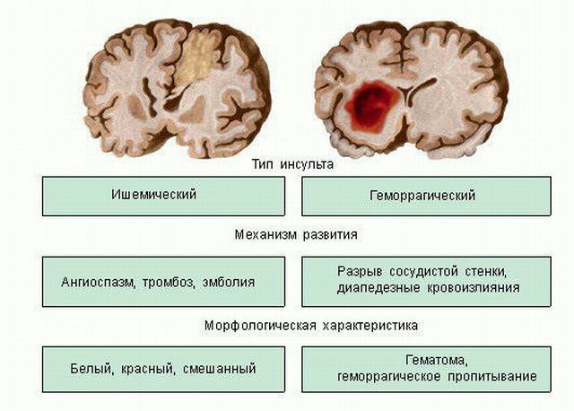 vrste moždanog udara