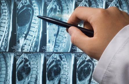 MRI prsne hrbtenice s kontrastom za diagnozo spondiloze