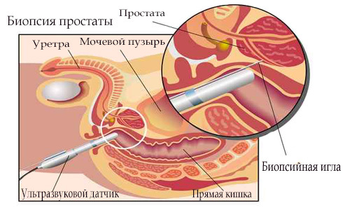 Gráfico de biópsia da próstata