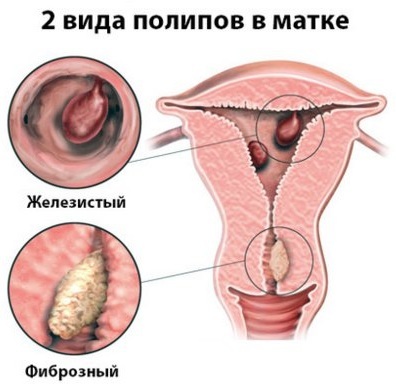Polip u cervikalnom kanalu. Da li je moguće zatrudnjeti, liječenje, krvarenje tijekom trudnoće, operacije, uklanjanje, kiretaža