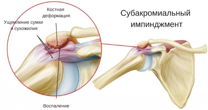 Subacromial shoulder impingement syndrome. What is it, symptoms, treatment of 1-2-3 degrees