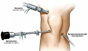 Kelio sąnario artroskopija: pasekmės ir reabilitacija po procedūros