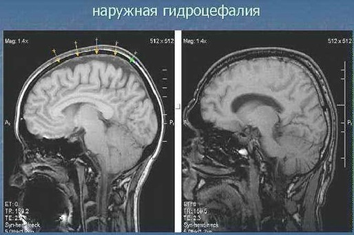 External cerebral replacement hydrocephalus in adults. What is it, prognosis treatment