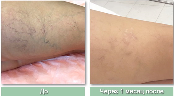 Capillary mesh on the legs. How to get rid of, ointments, cream, pills, laser