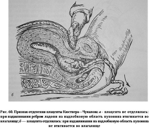Separazione della placenta. Segni di autori Alfeld, Küstner-Chukalov