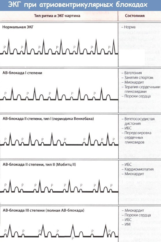 AV (atrioventrikulaarne) dissotsiatsioon EKG -l. Mida see tähendab, märgid lapsel, täiskasvanul