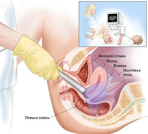 Ultrasound of pelvic organs can be performed in two ways: surface examination and internal