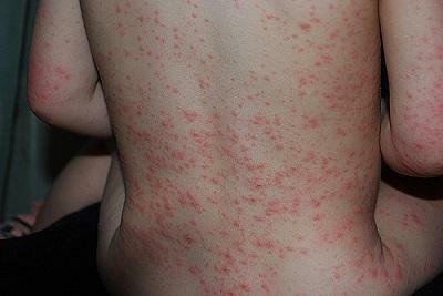 Allergische uitslag op het menselijk lichaam