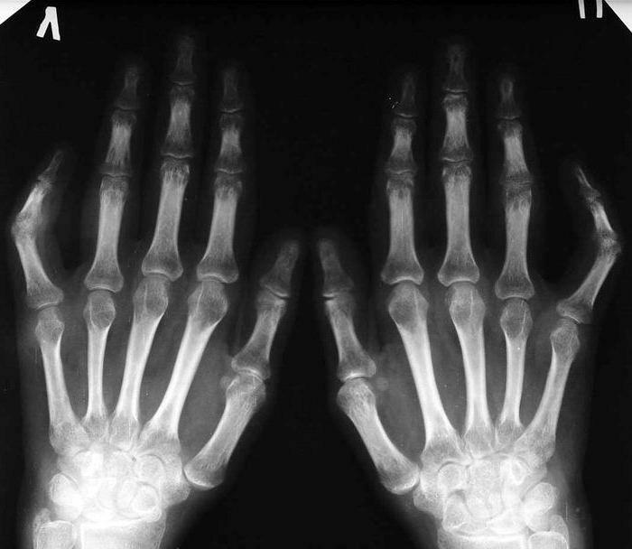 Rheumatoid arthritis on X-ray