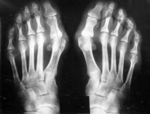 Röntgenfoto van de voet met ontstekingsproces