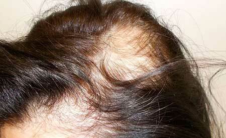 Diffus alopeci