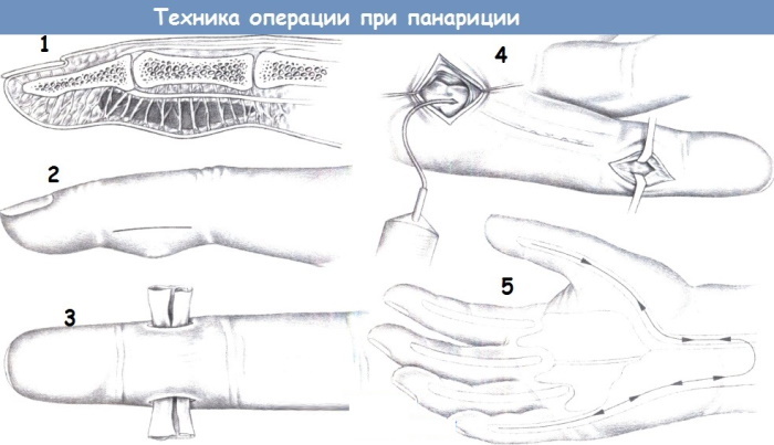 Ayak parmağı panaritium. Tedavi, semptomlar