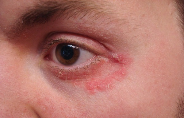 Dermatitis of the eyelids. Treatment, ointments and creams, photos, which doctor to go to