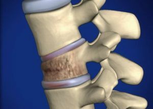 Vertebroplastia irá restaurar as funções de apoio da coluna vertebral