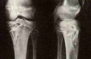 Abcissen dwalen voor röntgenfoto