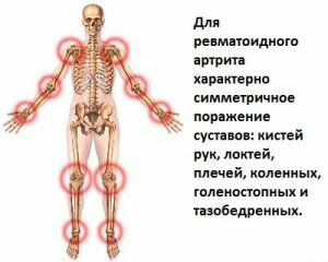 Reumatoïde artritis