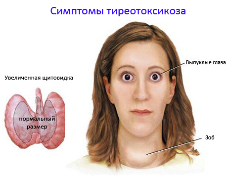 Symptoms of thyrotoxicosis