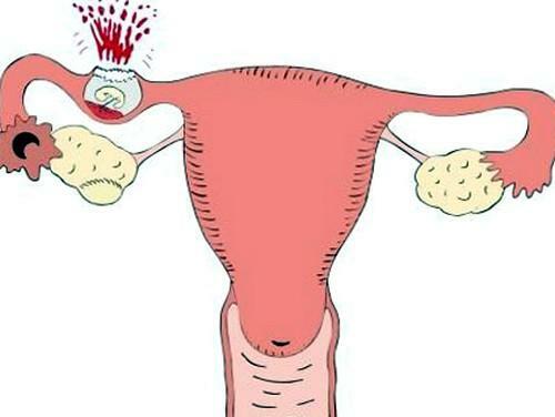 Rupture de la trompe de Fallope dans la grossesse extra-utérine