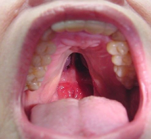 Suden suu lapsilla. Valokuvat ennen ja jälkeen leikkauksen, ulkonäön syyt, hoito